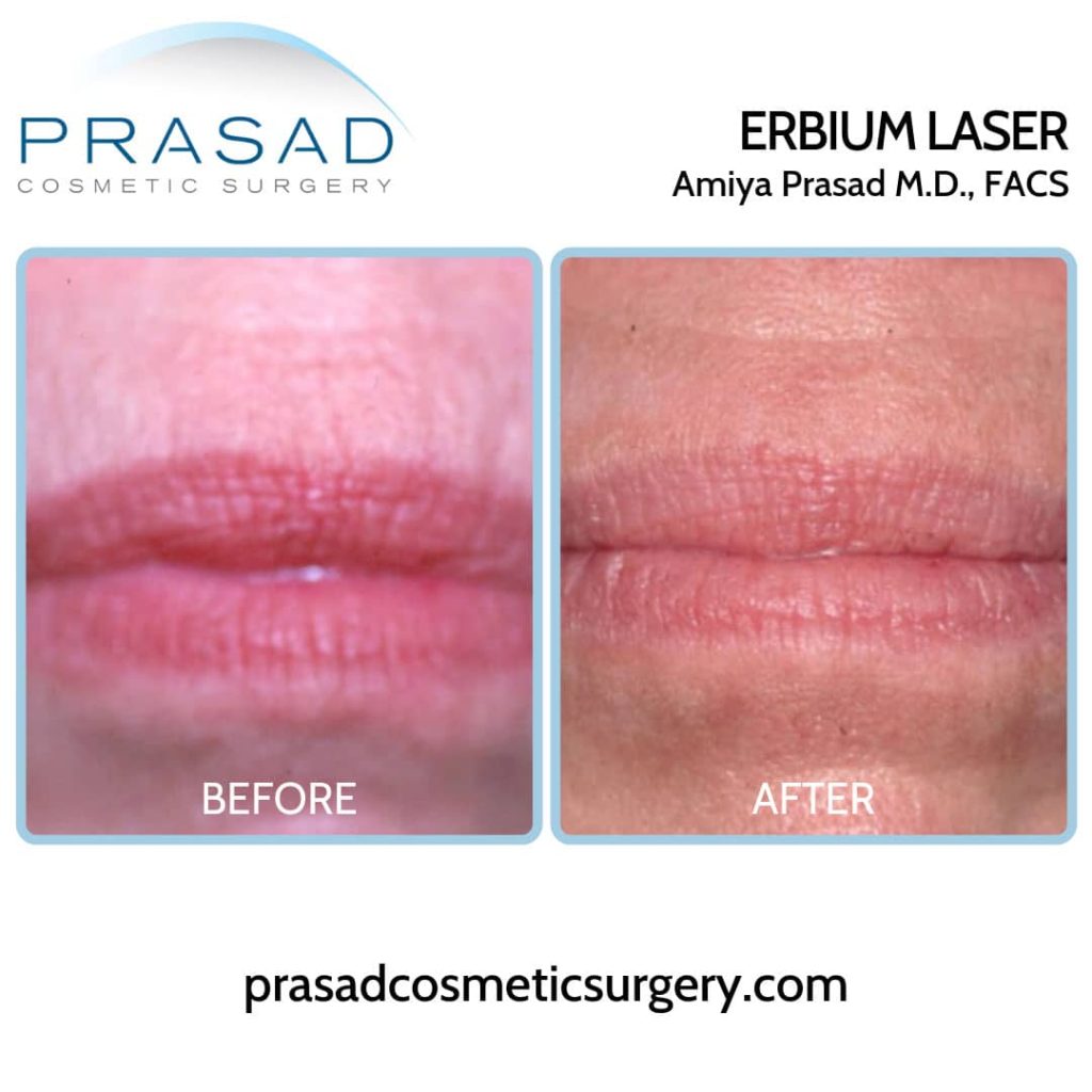 before and after erbium laser treatment for lines and wrinkles on lips