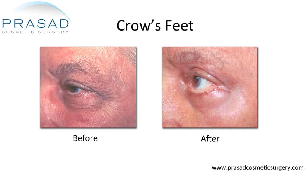 before and after Laser Treatment for Wrinkles around eyes or crow's feet