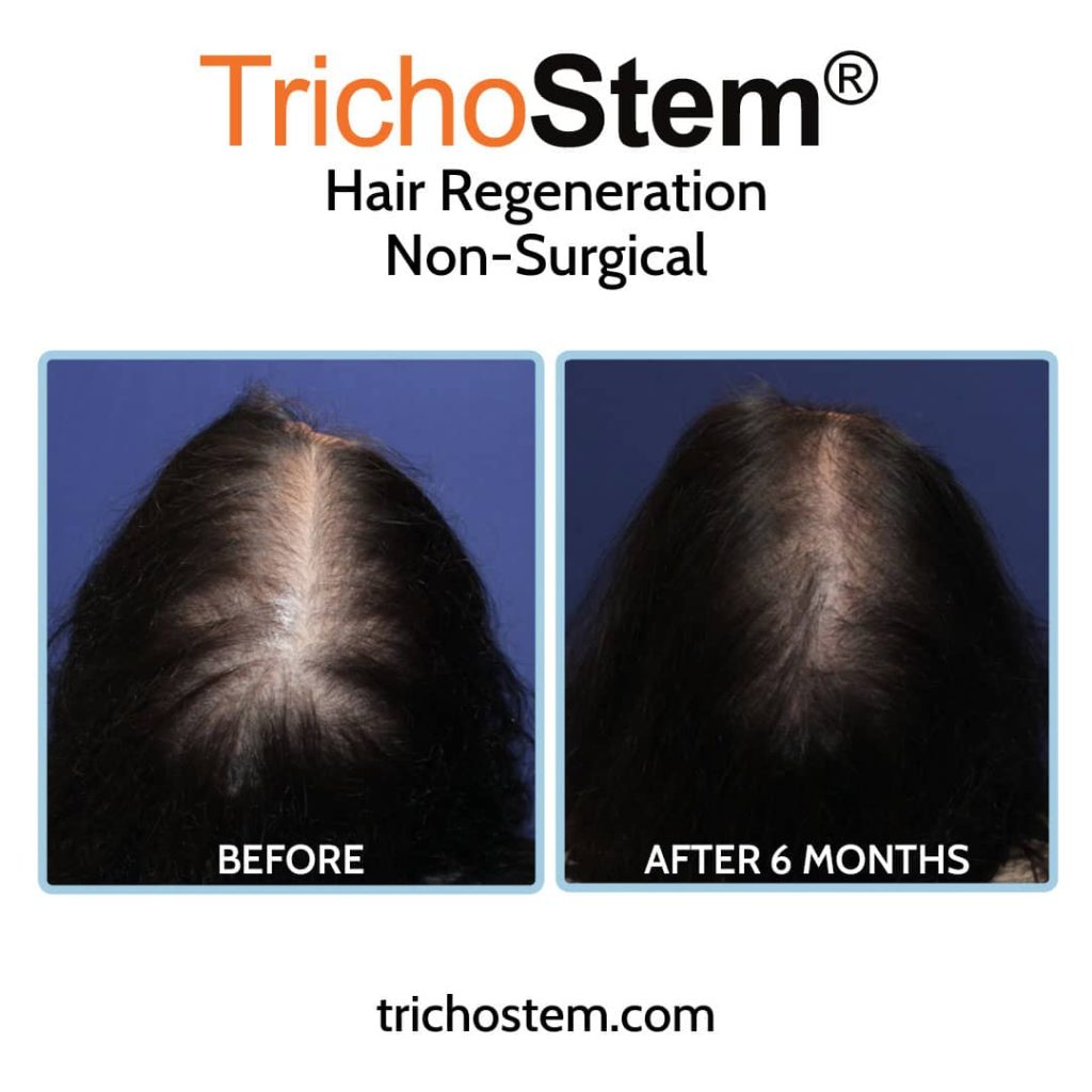 Hair Regeneration treatment for female hair thinning before and after results