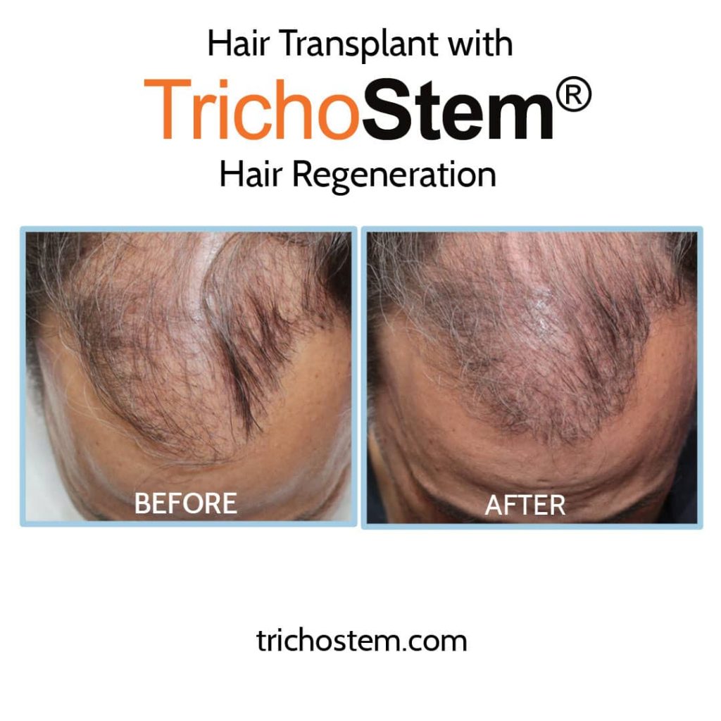 Hair transplant with hair regeneration results on male pattern hairloss with advance hair loss