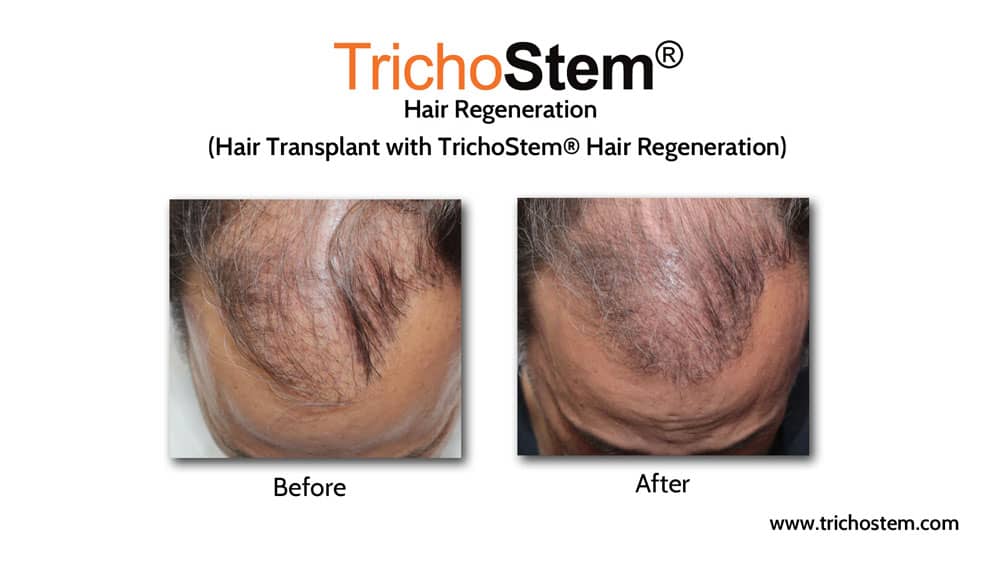 Hair transplant with hair regeneration results on male patient with advance hair loss