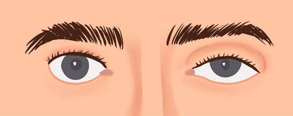 's syndrome (eyelid ptosis causes) illustration