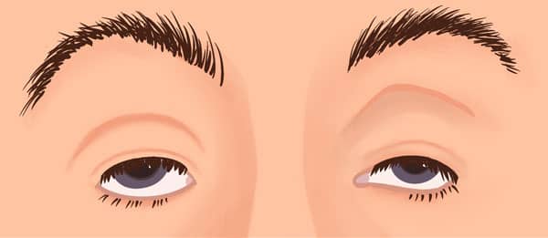 Myasthenia Gravis (ptosis eyelid causes) illustration