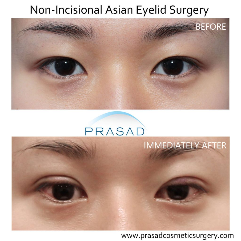 before and immediately after photo of patient recovering from Asian blepharoplasty