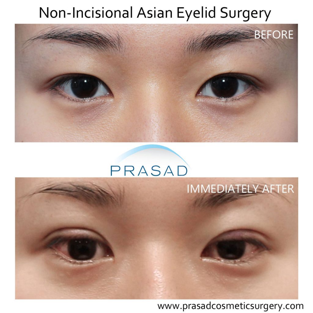 Incision double eyelid 2024 surgery recovery