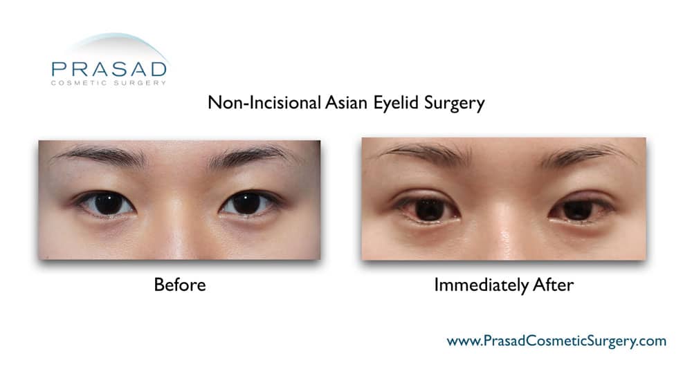 recovering from Asian blepharoplasty: before and immediately after photo of patient