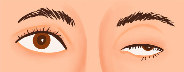 nerve palsy (ptosis eyelid causes) illustration