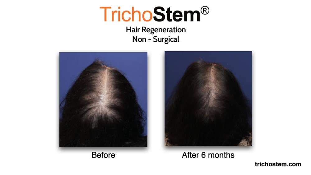Hair Restoration for female hair loss before and after 6 months results