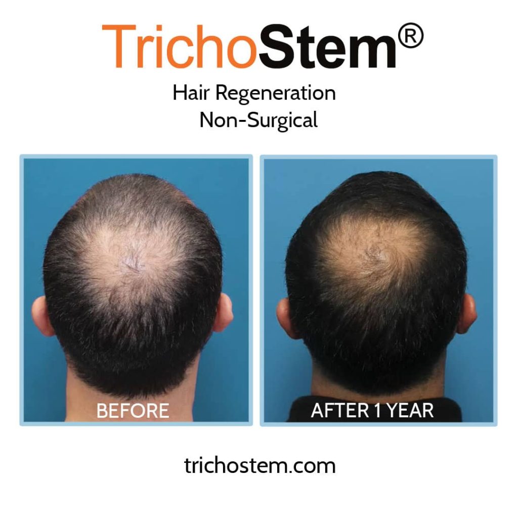 Trichostem hair regeneration treatment for hair thinning at crown area before and after 1 year