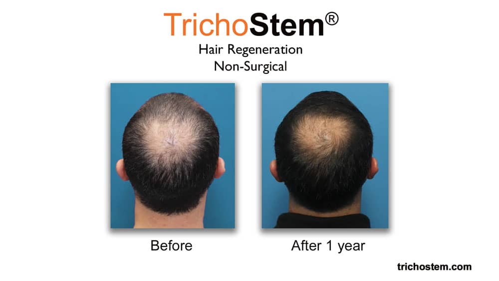 before and 1 year after Trichostem hair regeneration treatment for hair thinning at crown area