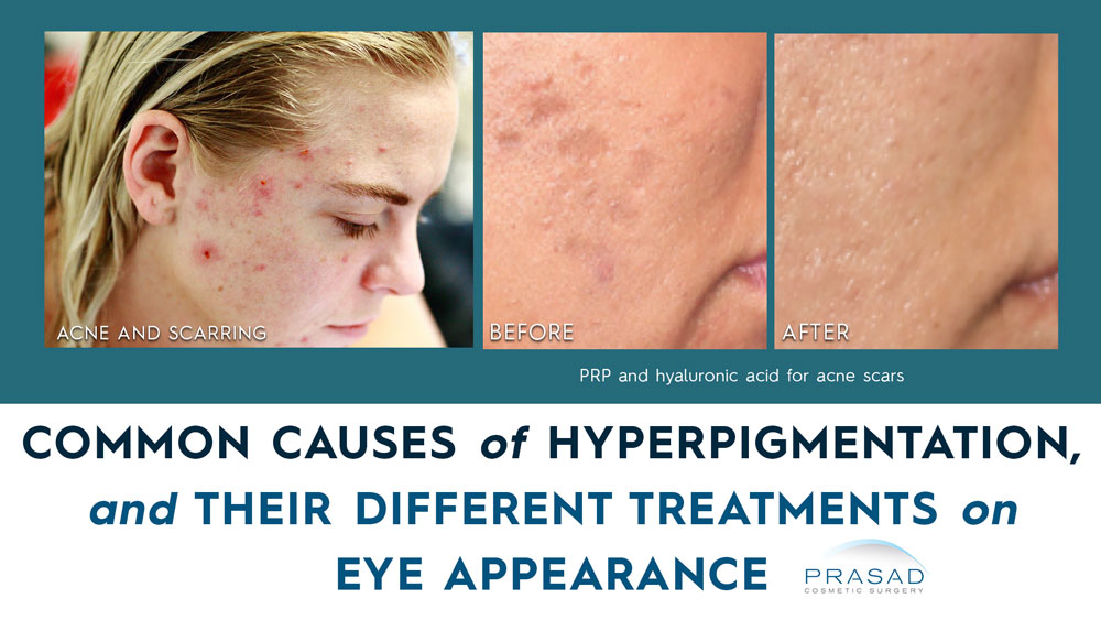 woman with acne and hyperpigmentation with the text 'common causes of hyperpigmentation and their different treatments'