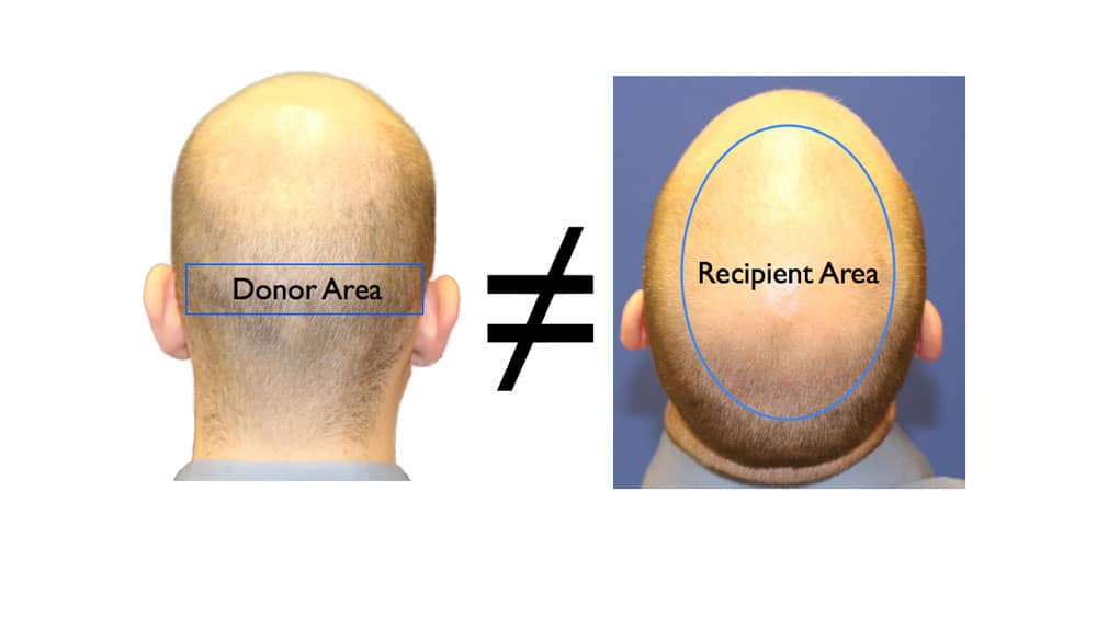 donor area mismatch with receiver area (hair thinning at crown area)