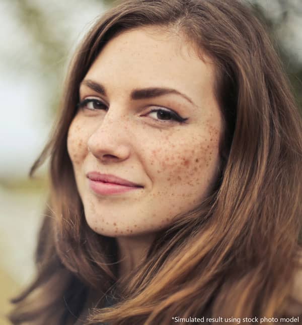 woman with post acne hyperpigmentation treatment