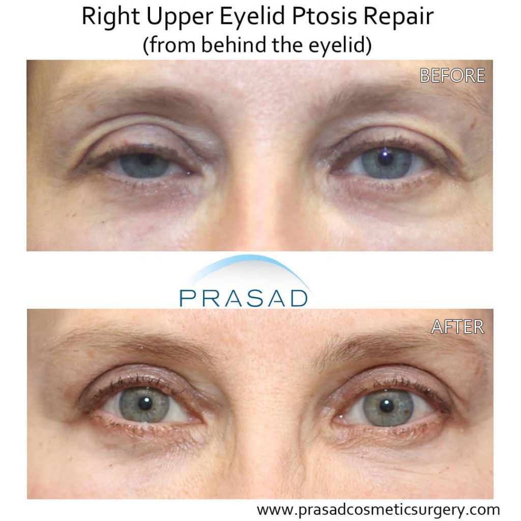 before and after ptosis eyelid correction on adult female patient