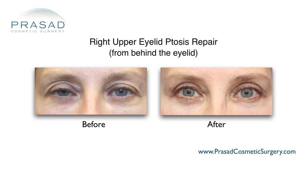 before and after ptosis eyelid correction surgery recovery