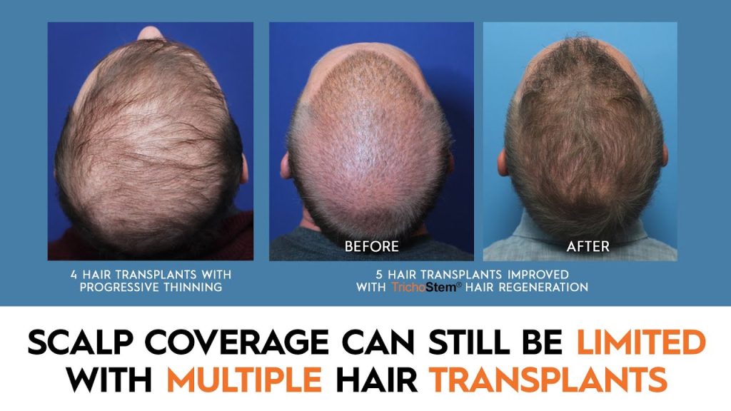 scalp coverage can still be limited with multiple hair transplants
