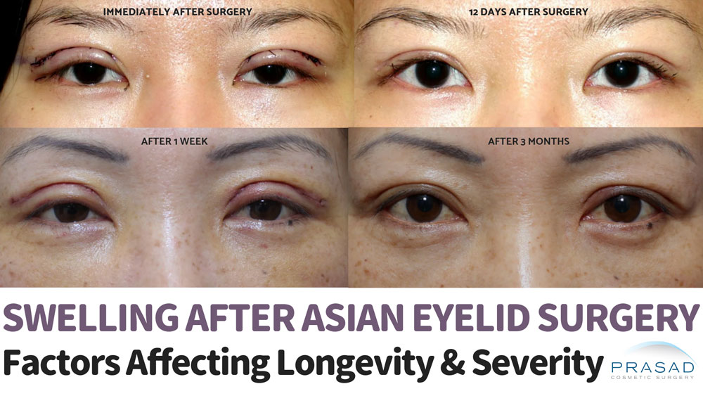 recovery photos of patients after Asian blepharoplasty.