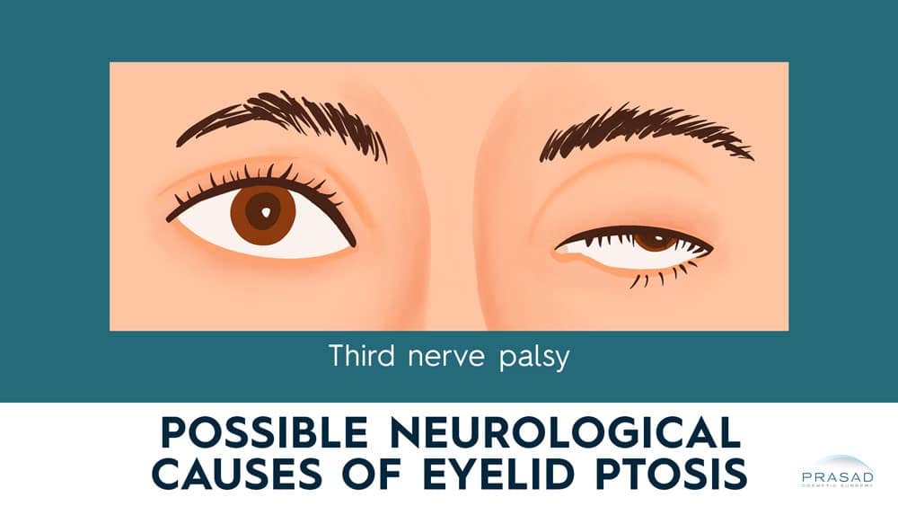 possible neurological causes of eyelid ptosis