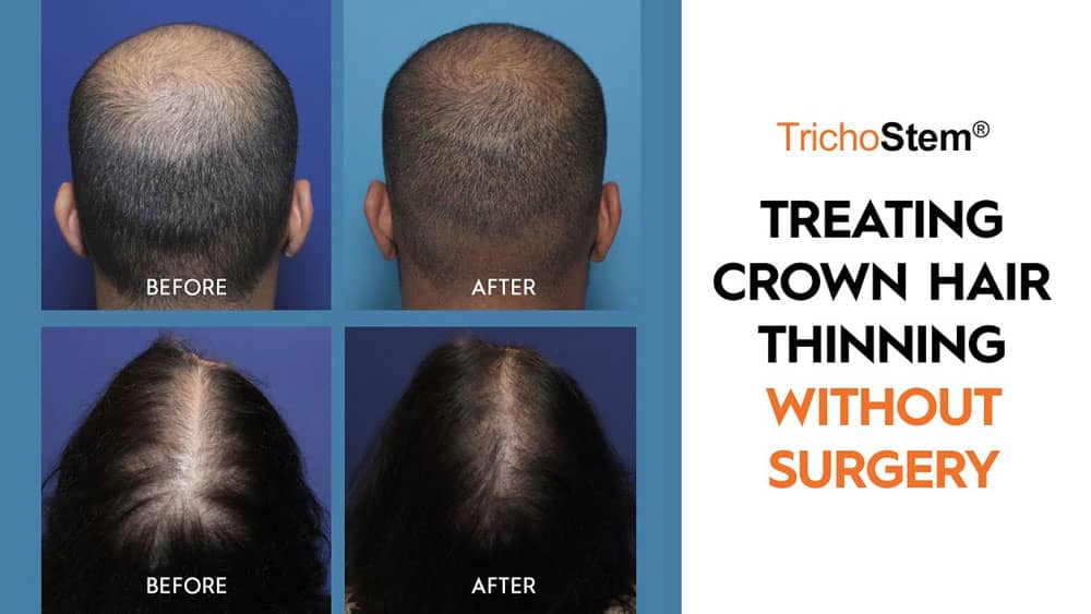 treating crown hair thinning without surgery