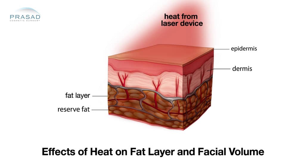 effects of heat on fat layer and facial volume illustration