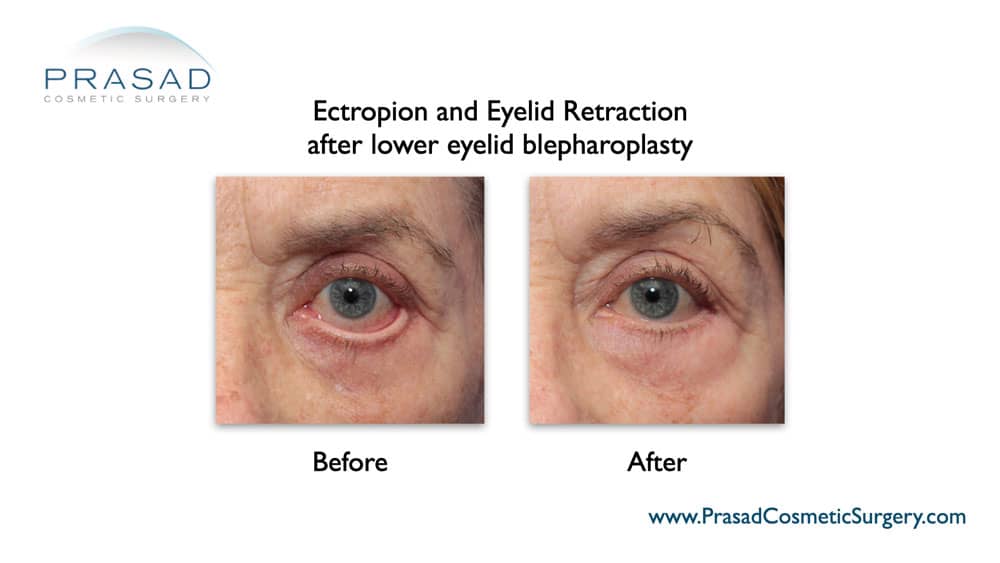 lower eyelid retraction revision surgery before and after