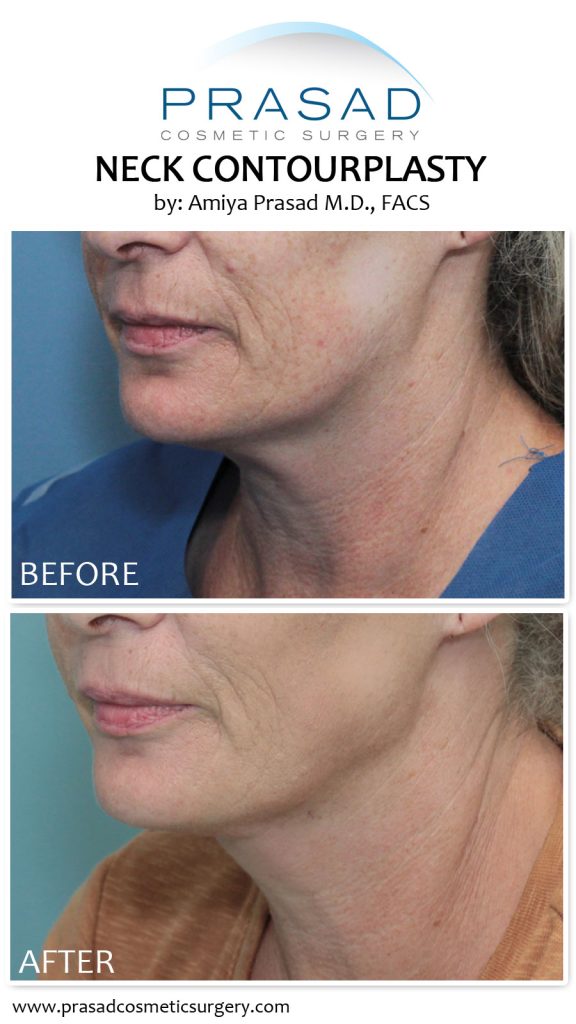 Neck Contourplasty is a procedure for sagging neck skin, and double chins for people too young for traditional neck lift surgery.