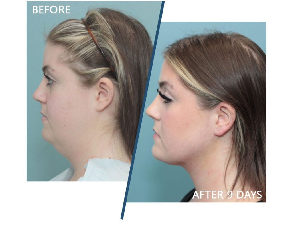 neck contourplasty before and after 9 days results