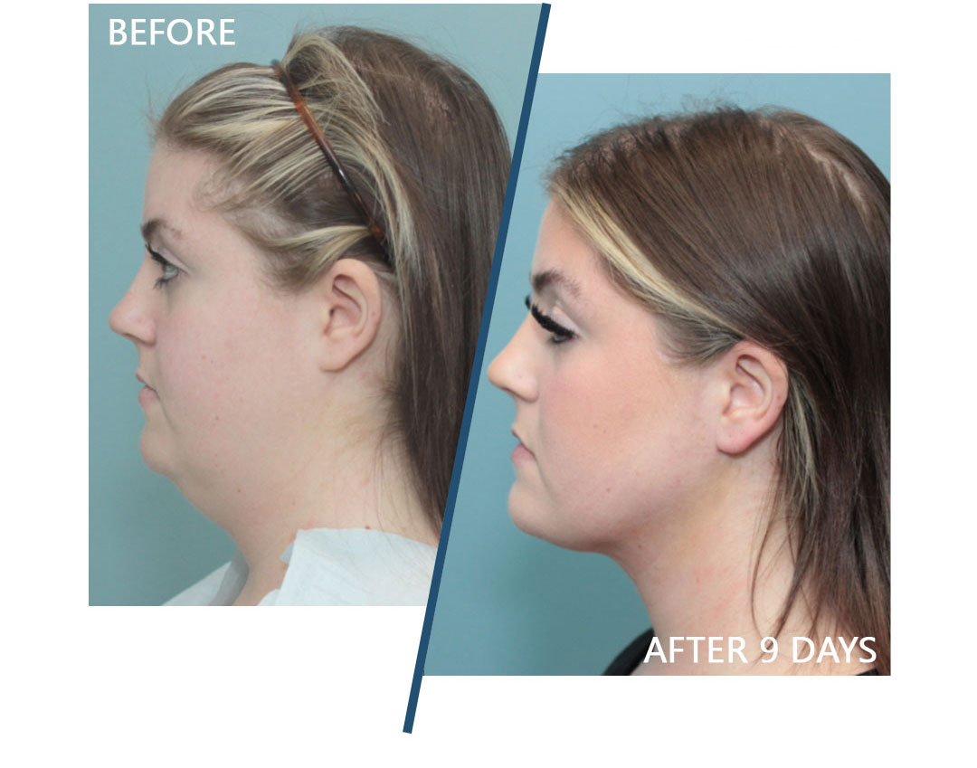 Artiste Plastic Surgery - Profile Nose and Artiste Neck Sculpt