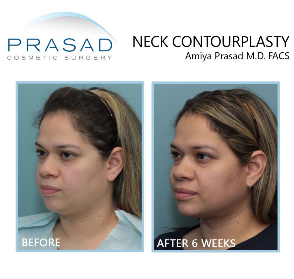 neck contourplasty before and after 6 weeks healing and results
