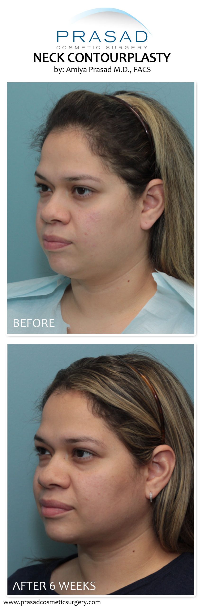 Mid Neck Incision Neck Contourplasty | NYC and Long Island, New York
