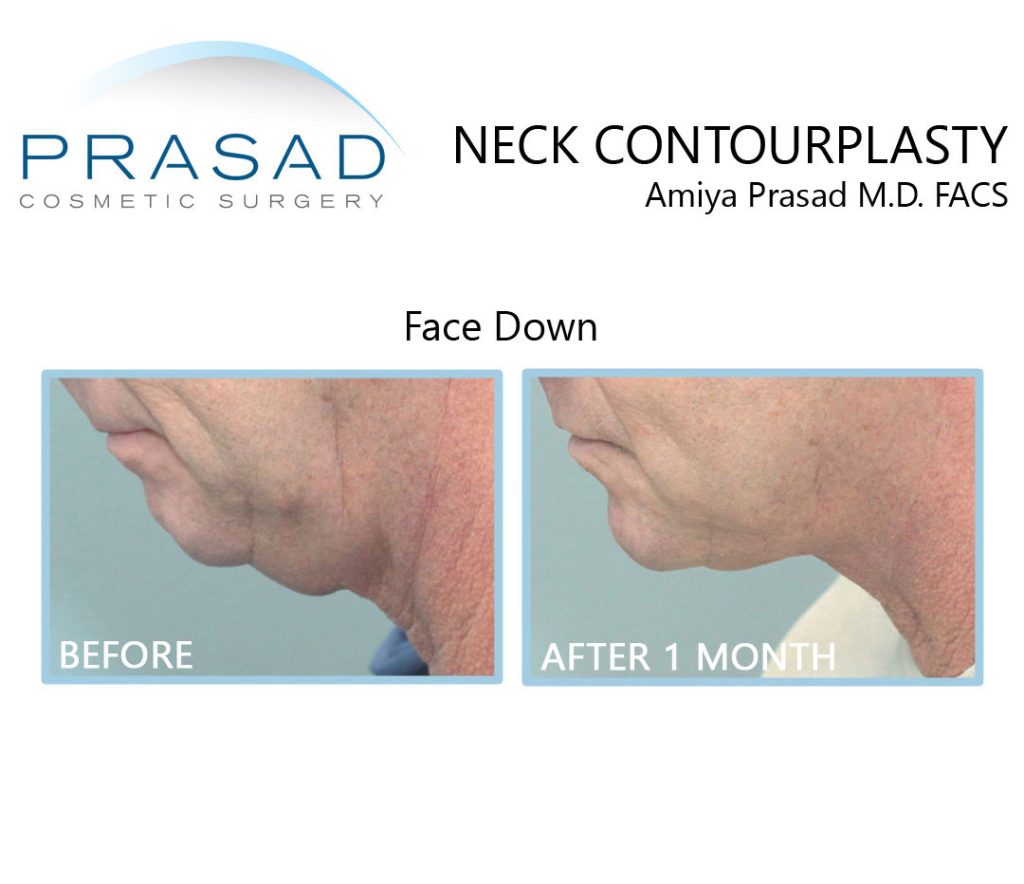 neck contourplasty on male patient before and after results