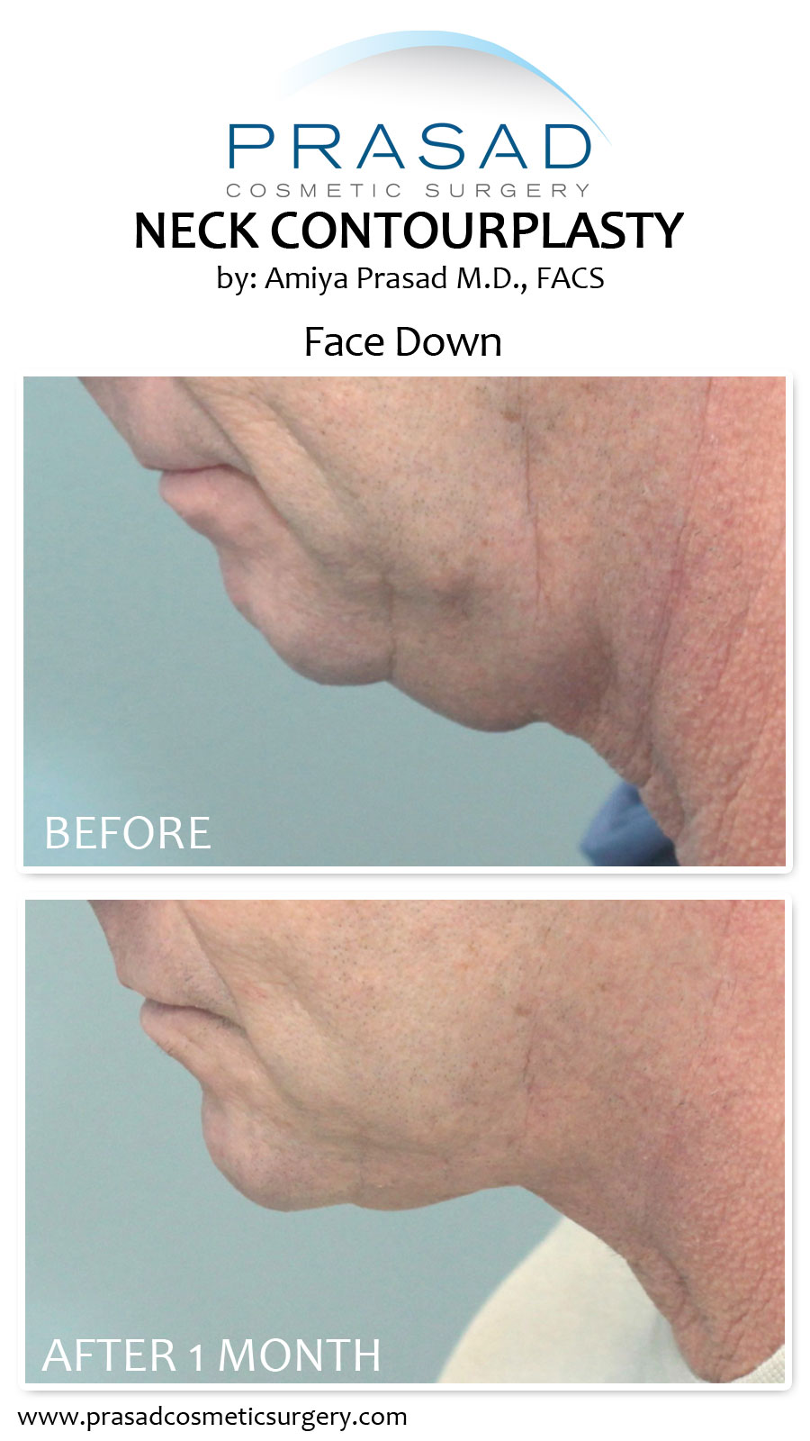 Neck Contourplasty for advanced neck sagging before and after