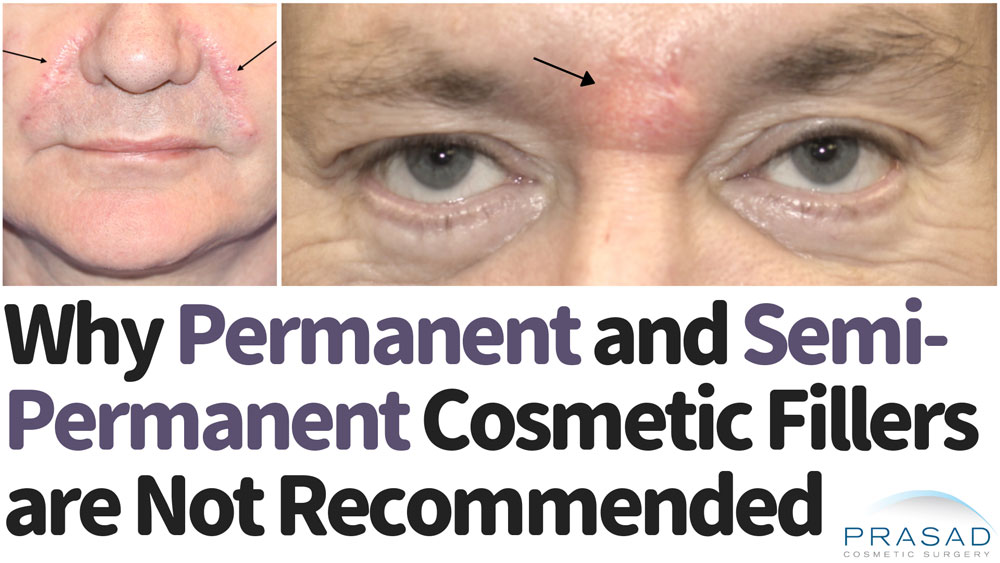 why permanent and semi-permanent cosmetic fillers are not recommended