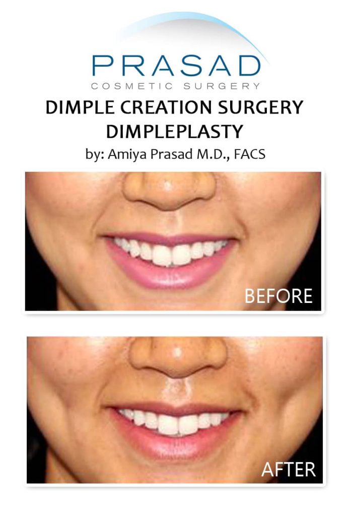 dimple surgery results before and after
