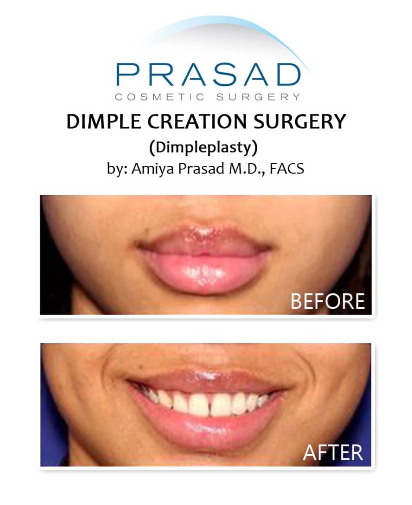 dimpleplasty before and after. Procedure performed by Dr. Amiya Prasad New York