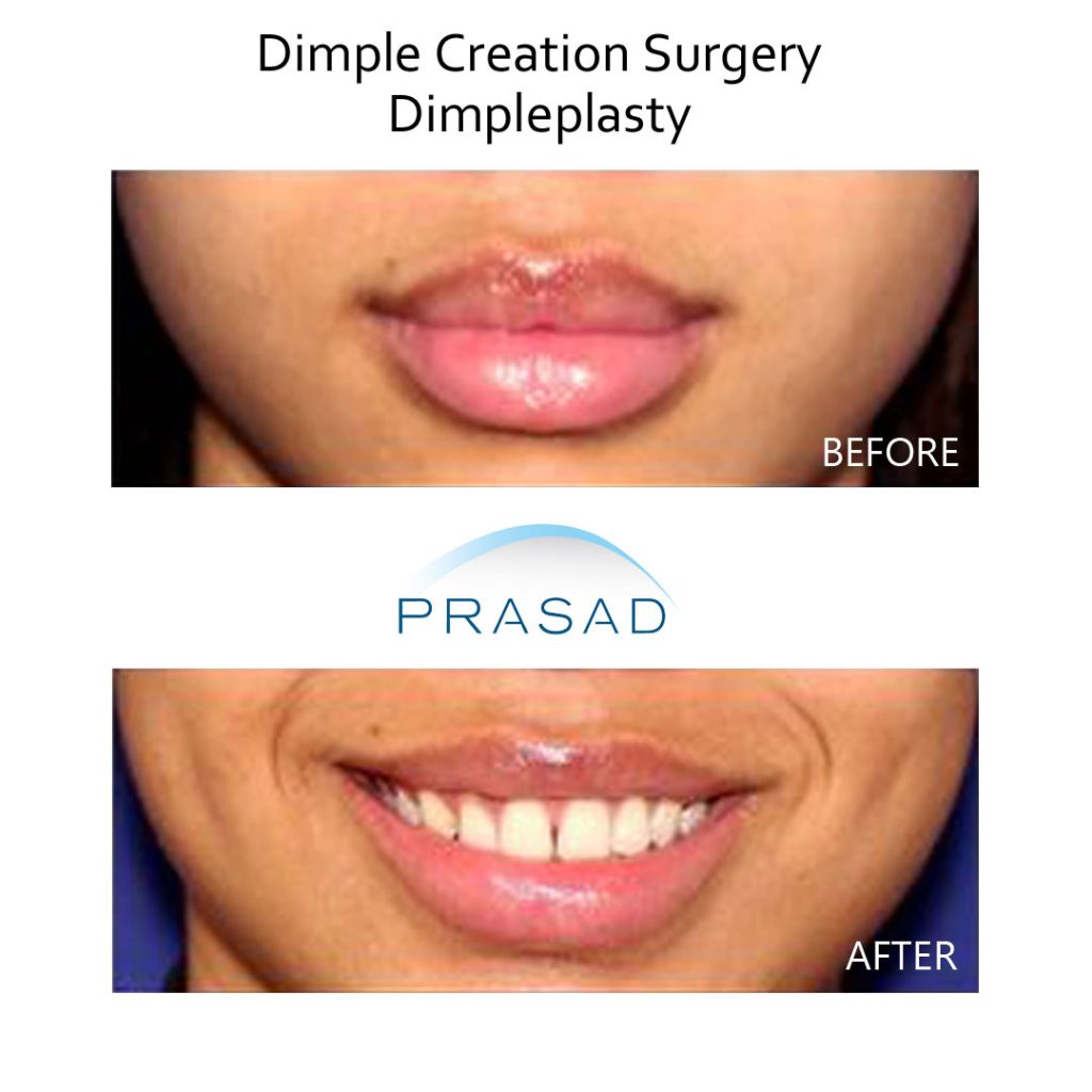 dimple creation surgery before and after. Procedure performed by Dr. Amiya Prasad New York