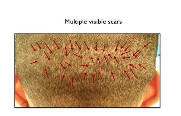 Multiple scars seen on patient's donor area