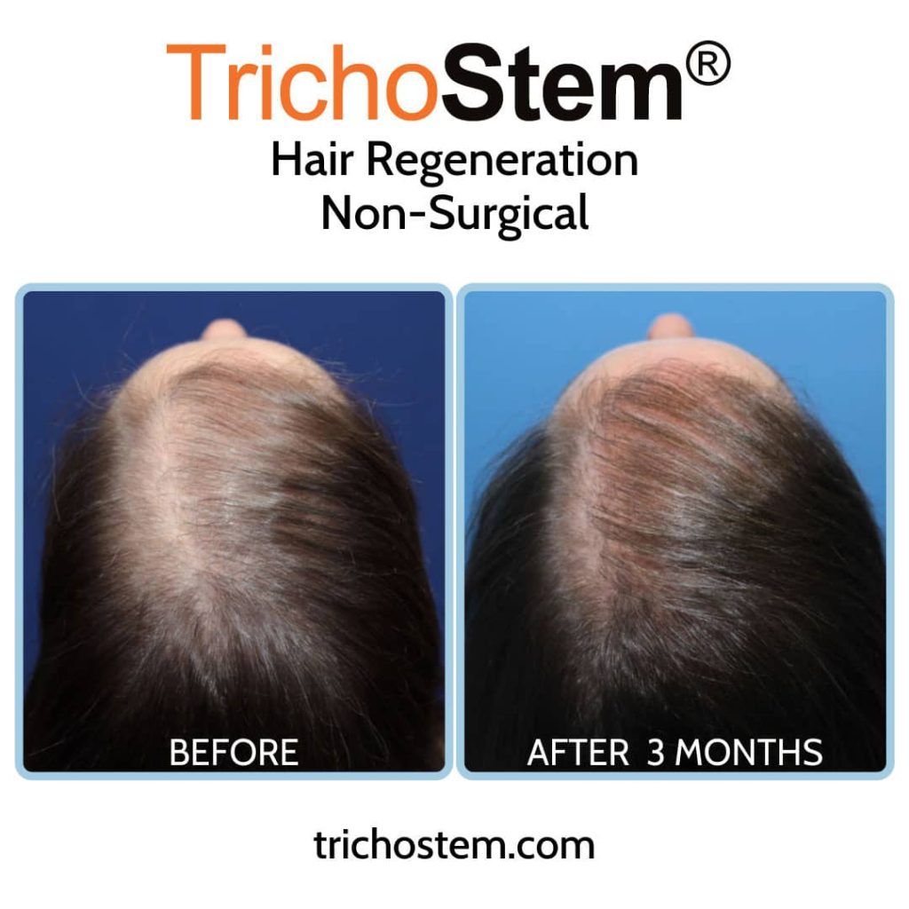 before and 3 months after hair regeneration shows regrowing of thinning hair female patient