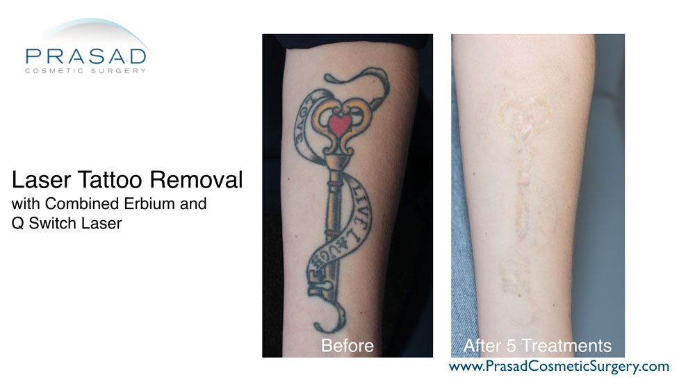 laser tattoo removal before and after 5 treatments at Prasad Cosmetic Surgery