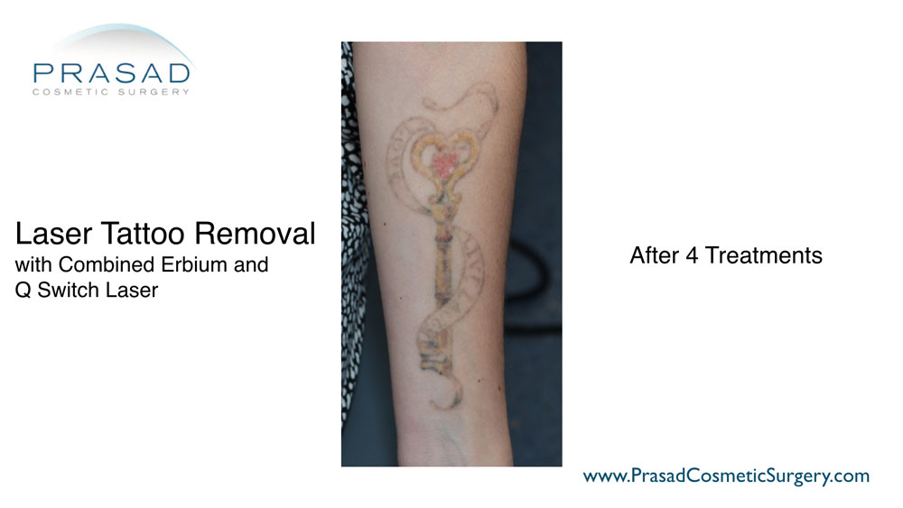 laser tattoo removal after 4 key treatments