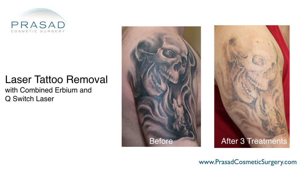 laser tattoo removal before and after 3 treatments at Prasad Cosmetic Surgery New York