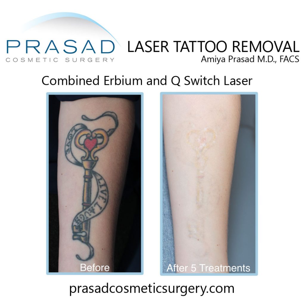 laser tattoo removal before and after with combined erbium laser and q switch laser