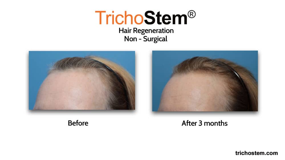 Female pattern baldness in 30s treatment before and after 3 months results
