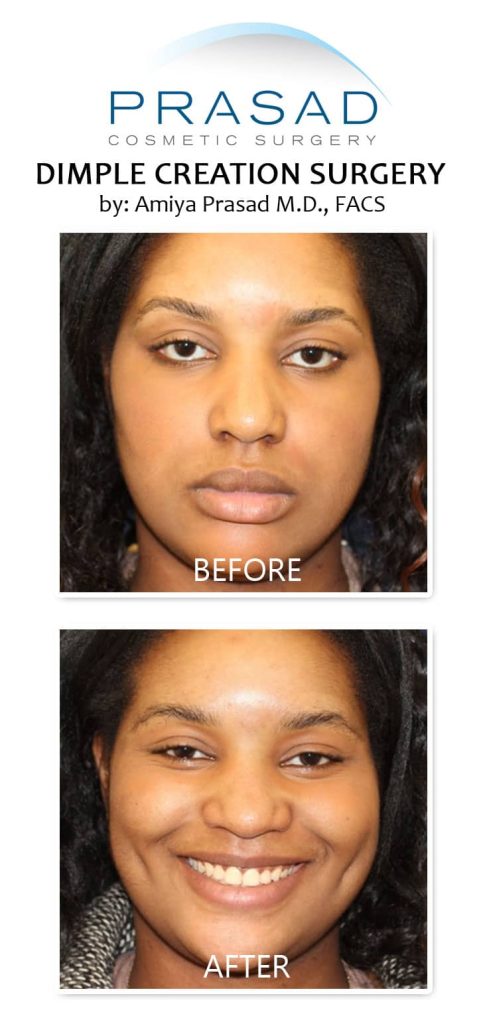 dimpleplasty before and after. Procedure performed by Dr. Amiya Prasad New York