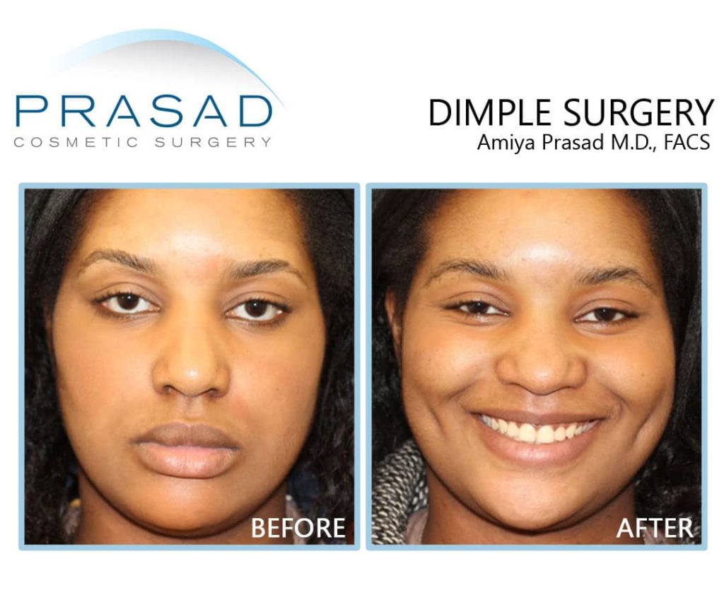 dimple creation surgery before and after. Procedure performed by Dr. Amiya Prasad New York