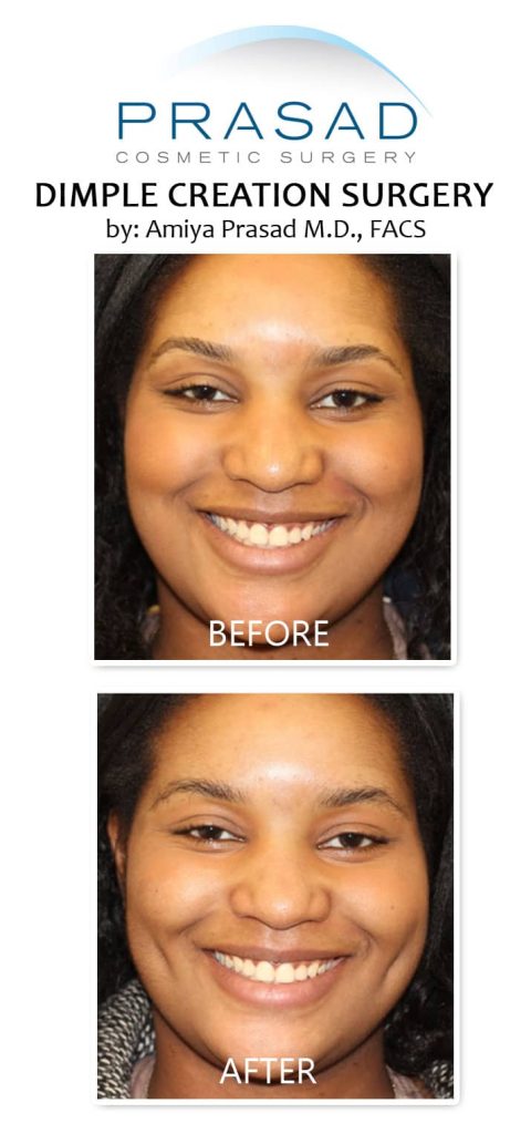 dimpleplasty by Dr. Amiya Prasad. before and after results