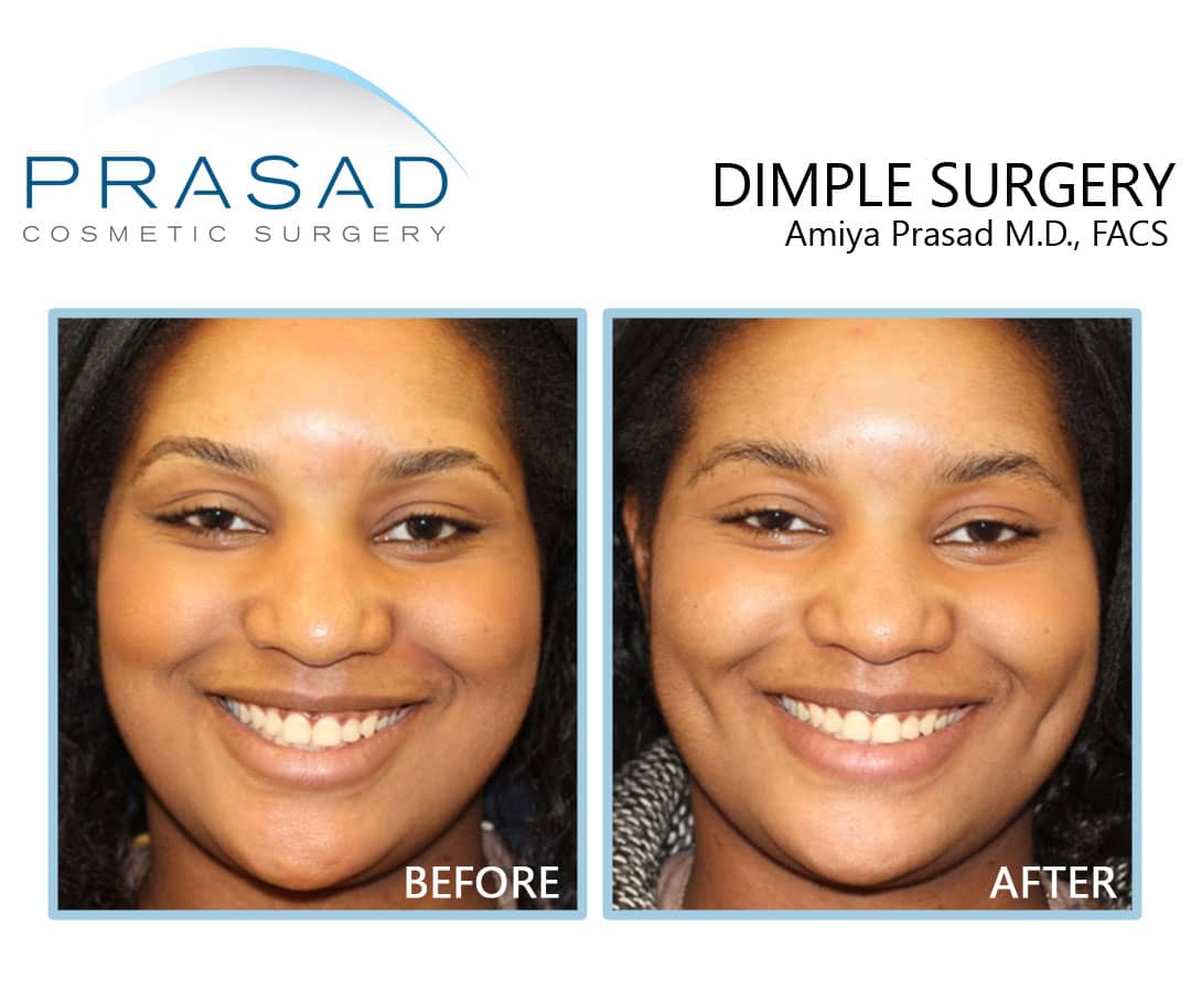 dimple creation surgery before and after results