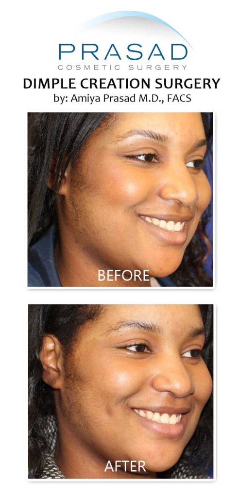 dimpleplasty on darker skin patient before and after