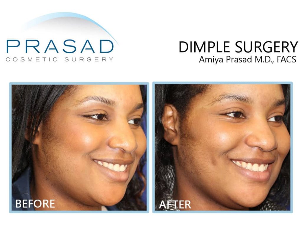dimple creation surgery on darker skin patient before and after