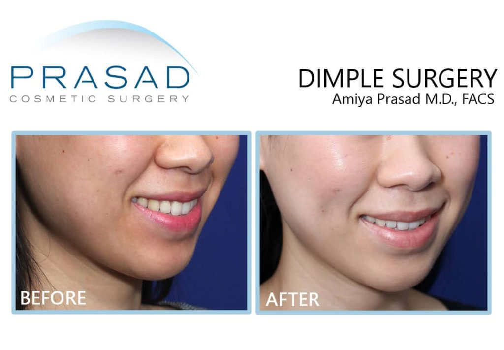 Dimple creation surgery before and after recovery